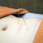 acupunctuur